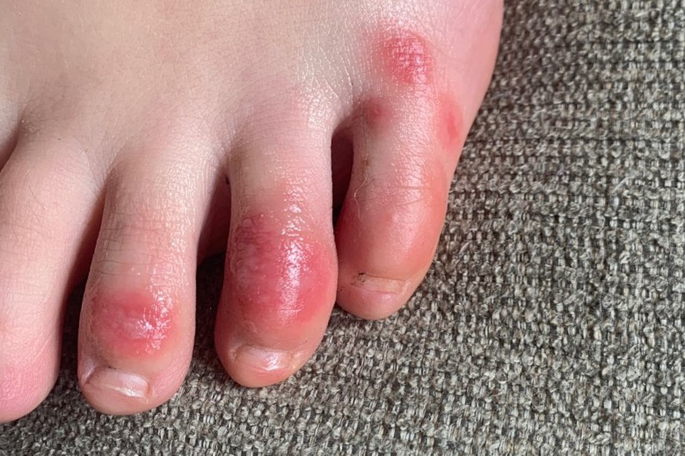 Covid Toes Red Sore And Sometimes Itchy Swellings Possible Rare